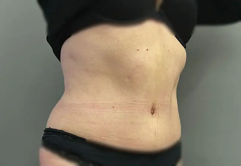 Flacher gestraffter Bauch nach Bauchdeckenstraffung