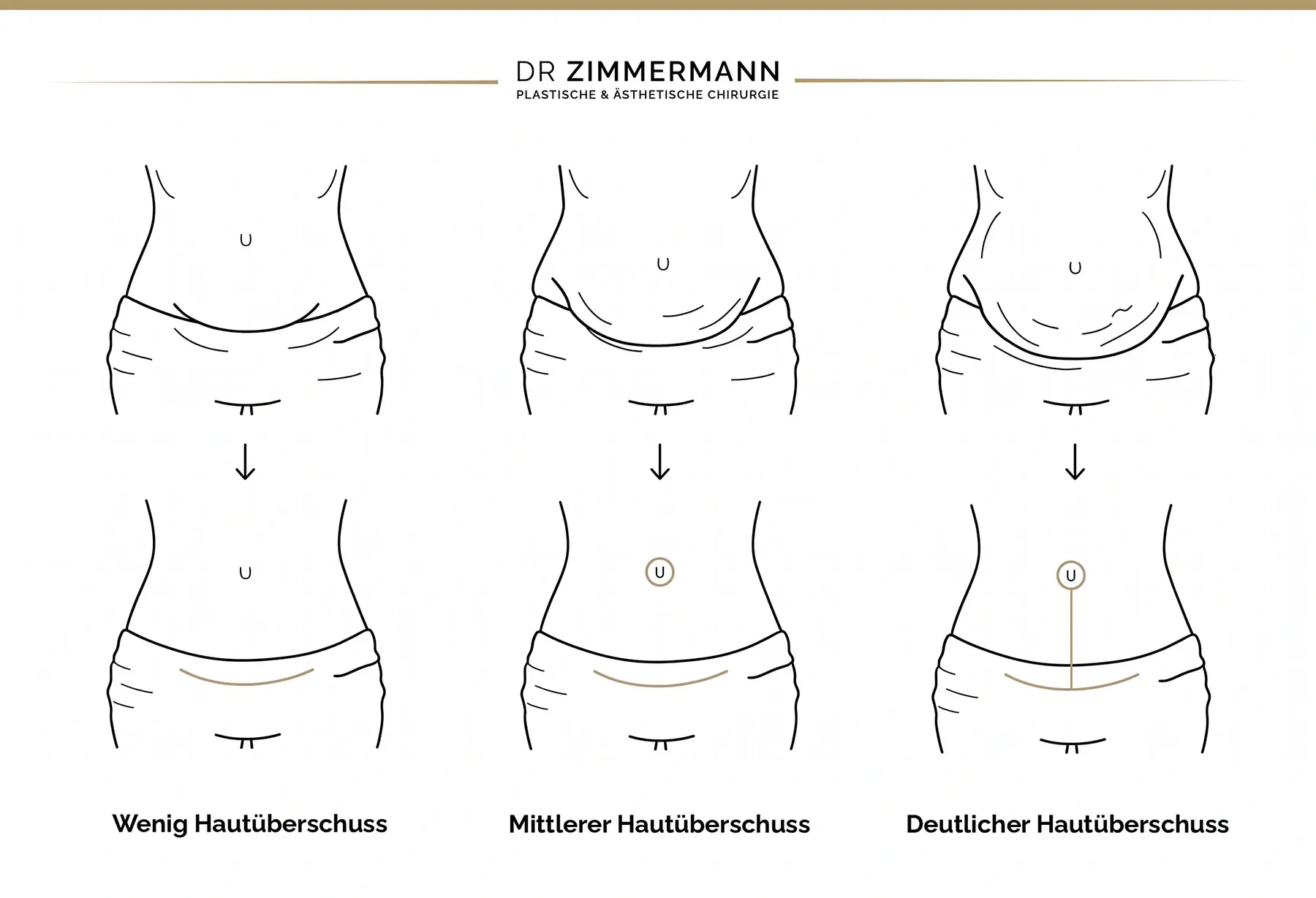 Grafik der Methoden und Schnittführungen einer Bauchdeckenstraffung Stuttgart