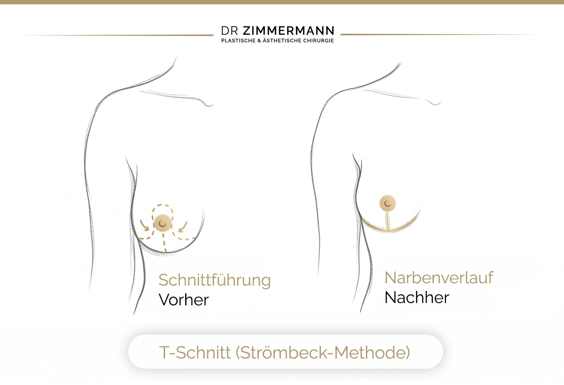 Schnittführung Narbenverlauf Brustverkleinerung