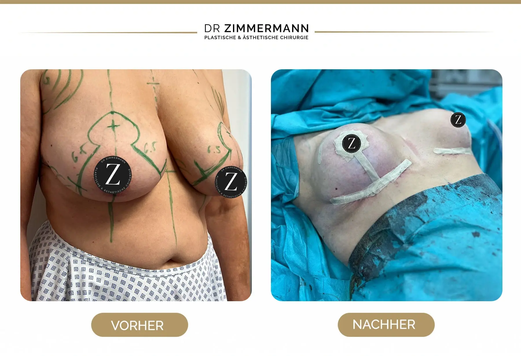Vorher Nachher Bild Brustverkleinerung