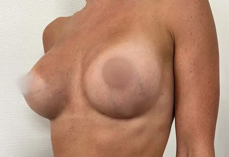 Brustverkleinerung nach der OP